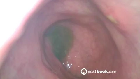 Sweet Tinqerbell – endoscope in my ass 2025-02-15 07 26